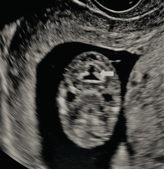 A transvaginal scan of the posterior fossa. The arrow on the top points to Cisterna magna.