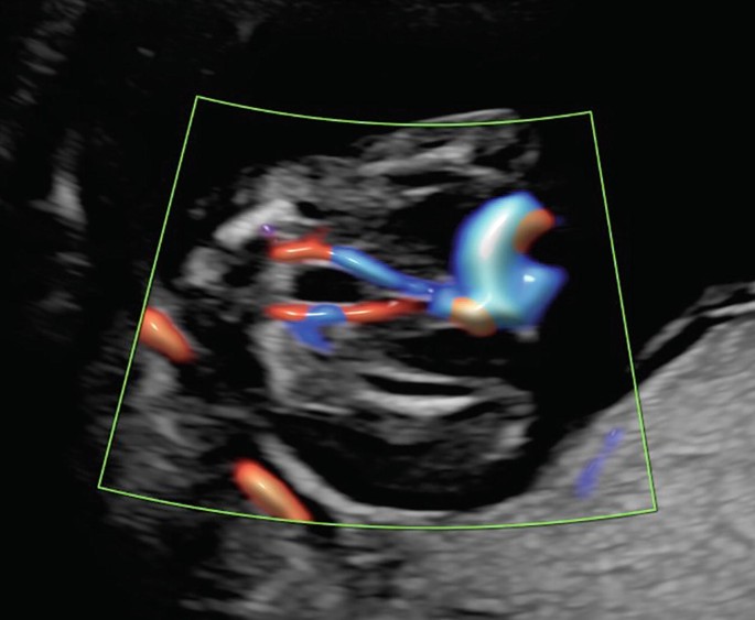 A transabdominal scan of the bladder. The two umbilical arteries adjacent to the bladder walls are highlighted.