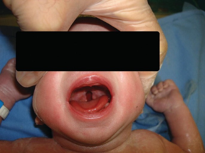 A photo of the face of an infant with his eyes masked to hide his identity. The head of the newborn is held by the hand of a man. The mouth of the child is open.