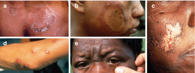 5 photographs of patients with different types of lesions formed due to different types of leprosy on the lower back, cheeks, elbows, and eye regions in a to e.