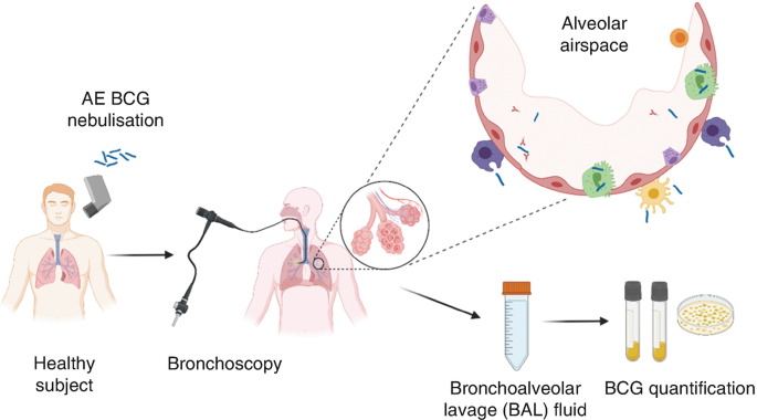 An illustration has a healthy subject on giving bronchoscopy bronchoalveolar lavage fluid and B C G quantification.