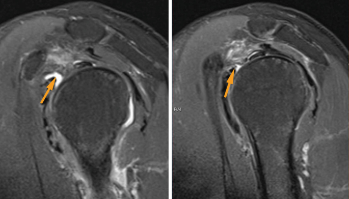 Two M R I scans of the right shoulder with arrows exhibit a cut in the ligament.