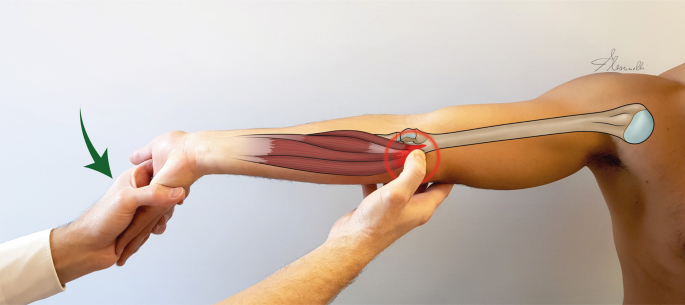 An image of a reverse Mill's test being performed on a patient. The patient's right hand is being held by the examiner's left hand with the palm facing sidewards, while the examiner's right hand is applying pressure to the patient's medial epicondyle.