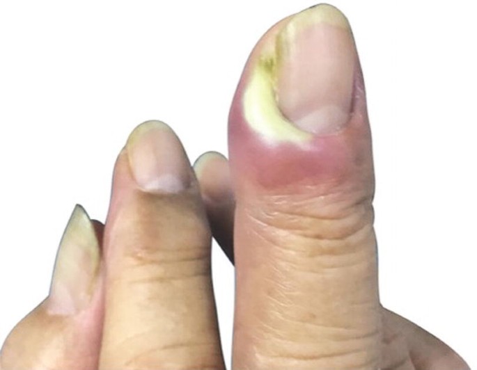 An “Ingrown Toenail” happens when the corner or edge of your toenail curves  and grows into the surrounding skin. This may cause pain… | Instagram