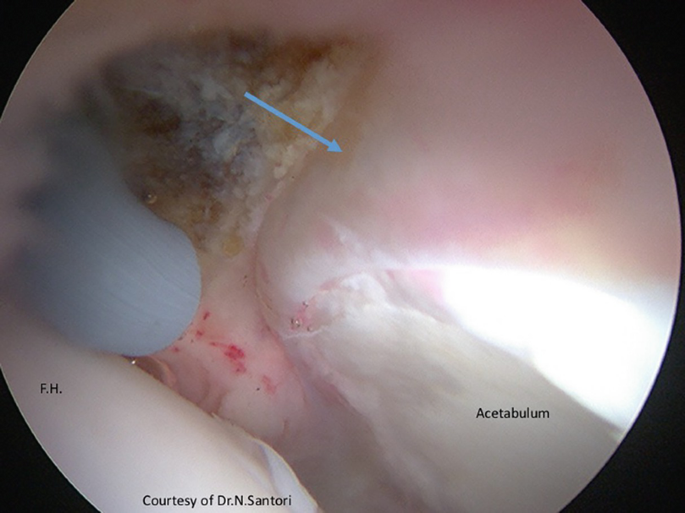 An arthroscopic photograph of the femoral head at the bottom left, the acetabulum at the bottom right, and the acetabular labrum at the center, indicated by an arrow.