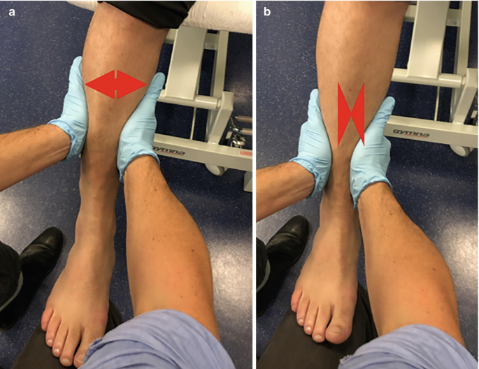 Bilateral ankle syndesmosis injury: a rare case report