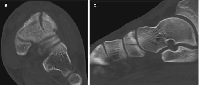 Two computed tomography scans in axial and sagittal views of a foot with a navicular stress fracture.