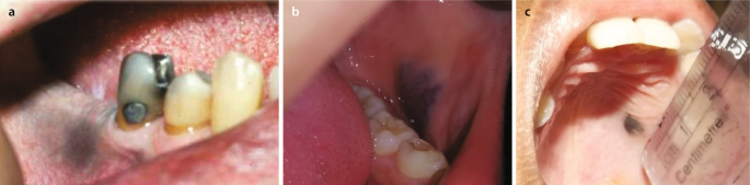A Black Spot on the Upper Gum for Many Years: Melanotic Macule | Springer  Nature Link