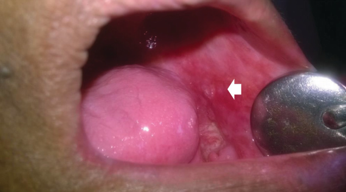 A Red Patch on the Cheek: Erythroplakia | SpringerLink