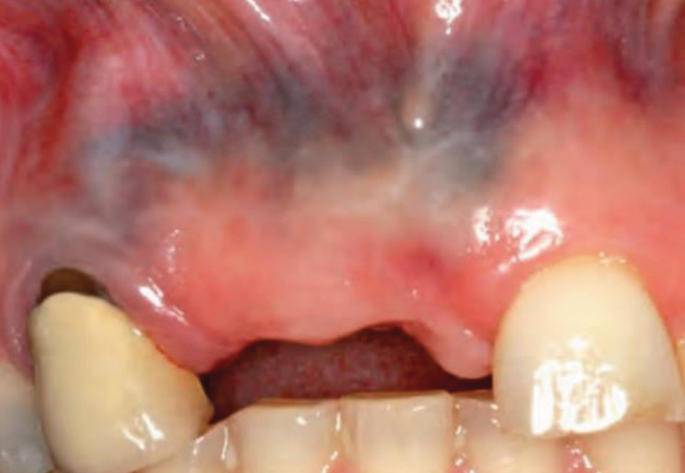 Esthetic Use of a Free Gingival Autograft to Cover an Amalgam Tattoo:  Report of Case