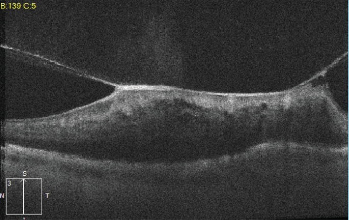 A photograph of O C T with viral retinitis.