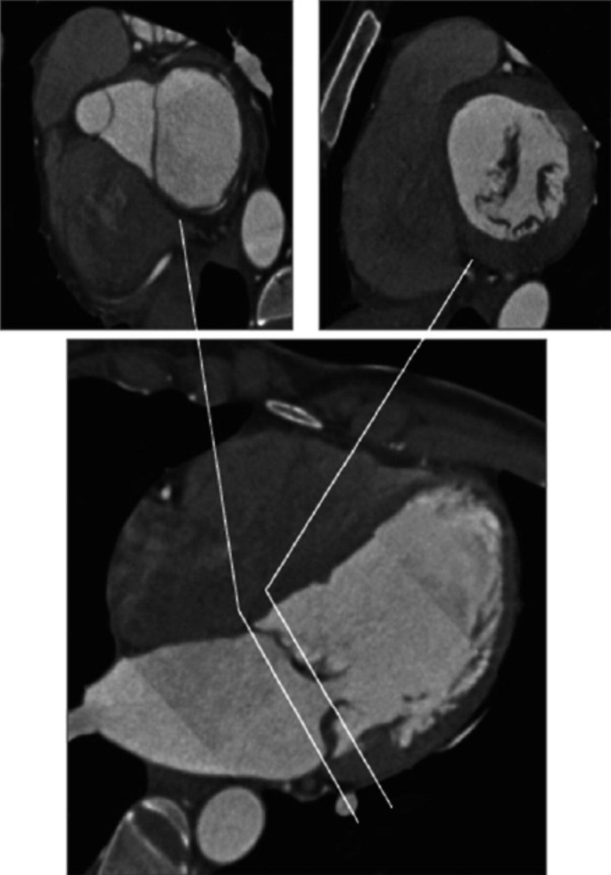 Two images at the top display the mitral annulus and mitral valve leaflets, and an image at the bottom reveals the mitral valve with markings.