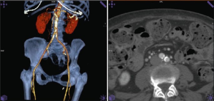 2 images. 1. The 3-D image of the spine and hip bone with certain internal organs highlighted. 2. The C T image highlights the vessel diameter, calcification, and tortuosity.