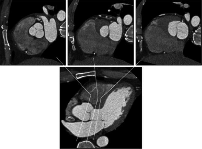 3 images at the top illustrate the cross sections of the aortic valve, L V O T, and anterior mitral leaflet in the upper panel. An image at the bottom displays the heart with markings on the aorta.