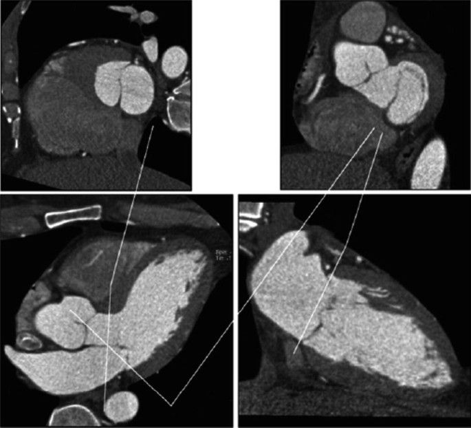 Four C T scans of L V O T, anterior mitral leaflet, and mitral annulus.