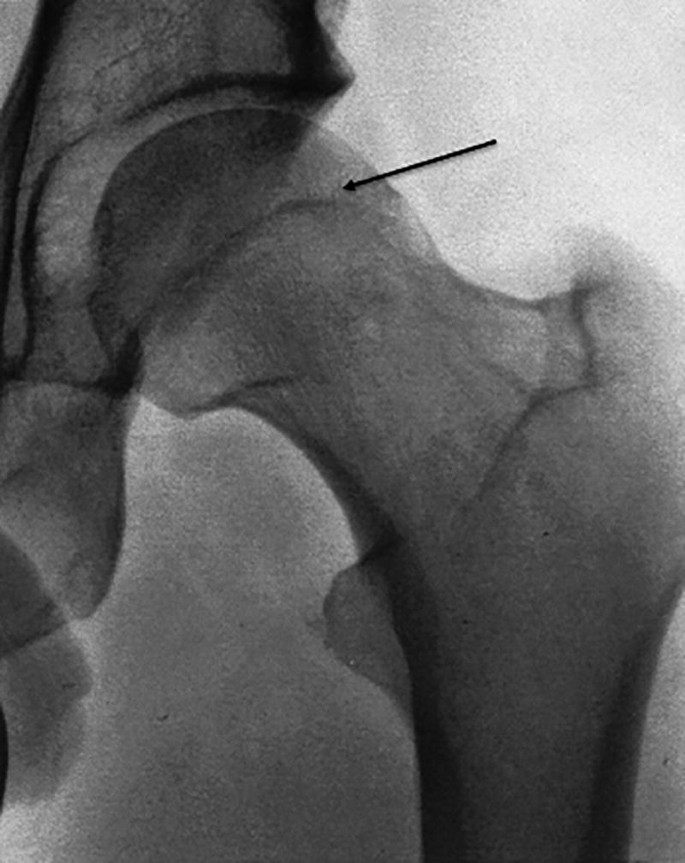 A radiographic image of the close-view of the femoral head region of a patient with adolescent C A M impingement. The arrow mark indicates the extension of the femoral epiphysis.