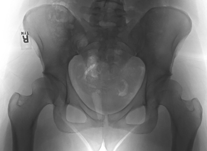 A radiographic image of the pelvic region of a patient with bilateral acetabular dysplasia. A partially covered femoral head by bony acetabulum is observed.