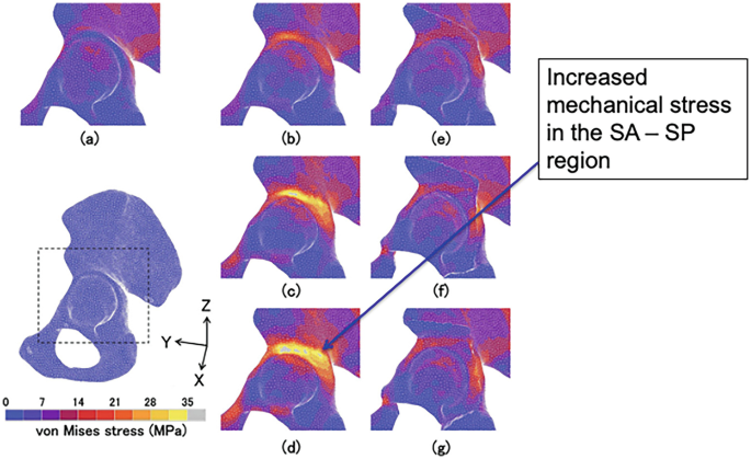 7 sets of von Mises stress images of the femoral head region in the hip with normal coverage in a to g. The bright area above the femoral head in d represents the increased mechanical stress in the S A-S P region. A von Mises stress image on the bottom left marks the femoral head region based on X, Y, and Z planes. A gradient scale for von Mises stress, megapascal ranges from 0 to 35, is at the bottom left.