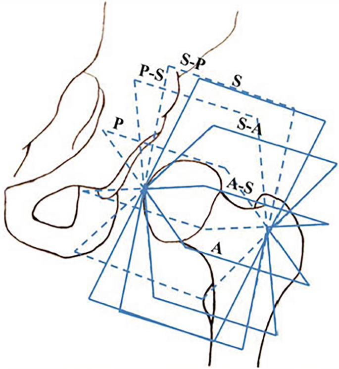 An illustration represents the 3-D M R I data reformatted around the femoral neck axis like a rotating frame. Each frame is labeled P, P-S, S-P, S, S-A, A-S, and A.