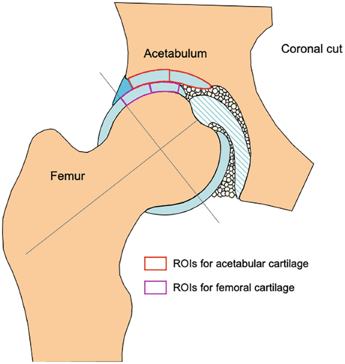 An illustration of a femur and acetabulum joint region with a coronal cut on the right. The R O Is for acetabular cartilage, and femoral cartilage is marked. 2 slanting lines intersecting each other are observed on the femur bone.