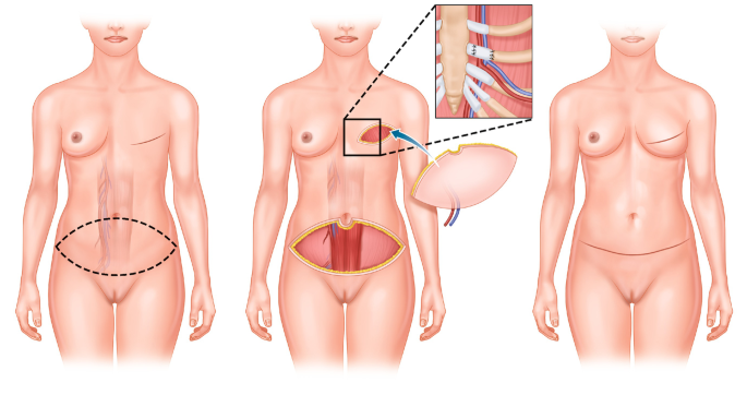 Double Bubble Boobs - What is it? How & Why This Deformity Occurs & How it  Can Be Fixed - Linia Cosmetic Surgery