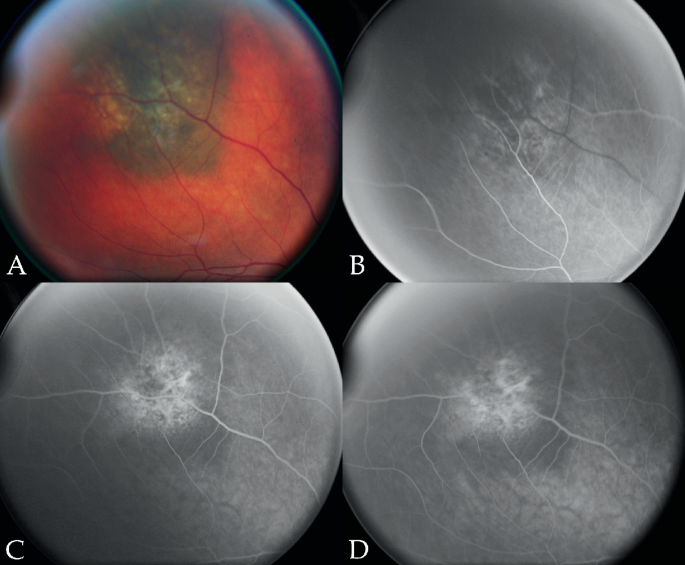 4 O C T scans of the eye. A. A big dark patch is observed in the center, with fine capillaries emerging from the right to the left. B-D. Dark and light patches at the center with bright capillaries all around.