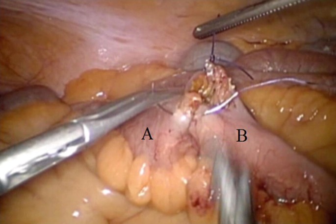 A photograph of the surgical closing of the anastomosis with an absorbable suture. It marks the common channel, which is on the left, and the biliary limb on the right.