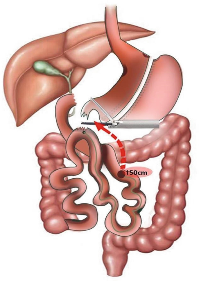 A diagram of the alimentary canal from the stomach to the large intestine. A part of the stomach is cut off to form a new stomach pouch, and 150 centimeters of the small intestine are removed using surgical equipment.