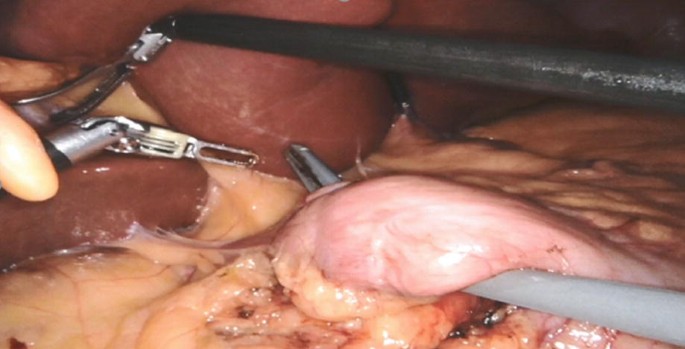 A surgical photo of the small intestine's duodenum region with surgical tools. A window is created to carry out further operations.