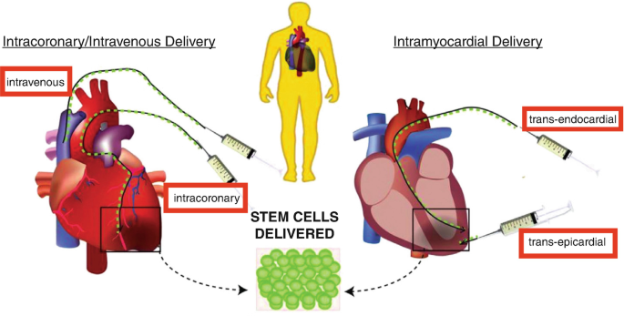 A chart for stem cell delivery into the targeted area. On the left, it has an illustration of a human heart, in which stem cells are delivered intravenously or intracoronary. On the right, it depicts intramyocardial delivery. It can be both trans-endocardial and trans-epicardial.