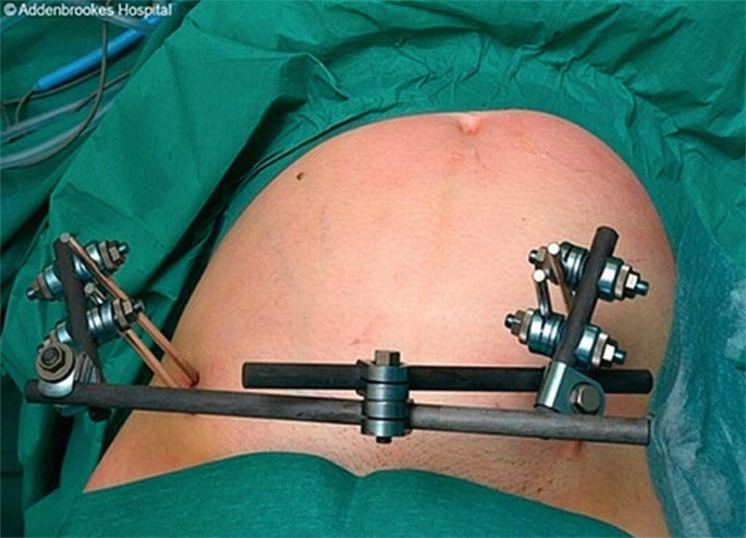 Infant Umbilical Navel Hernia Truss Belt AM-PPB