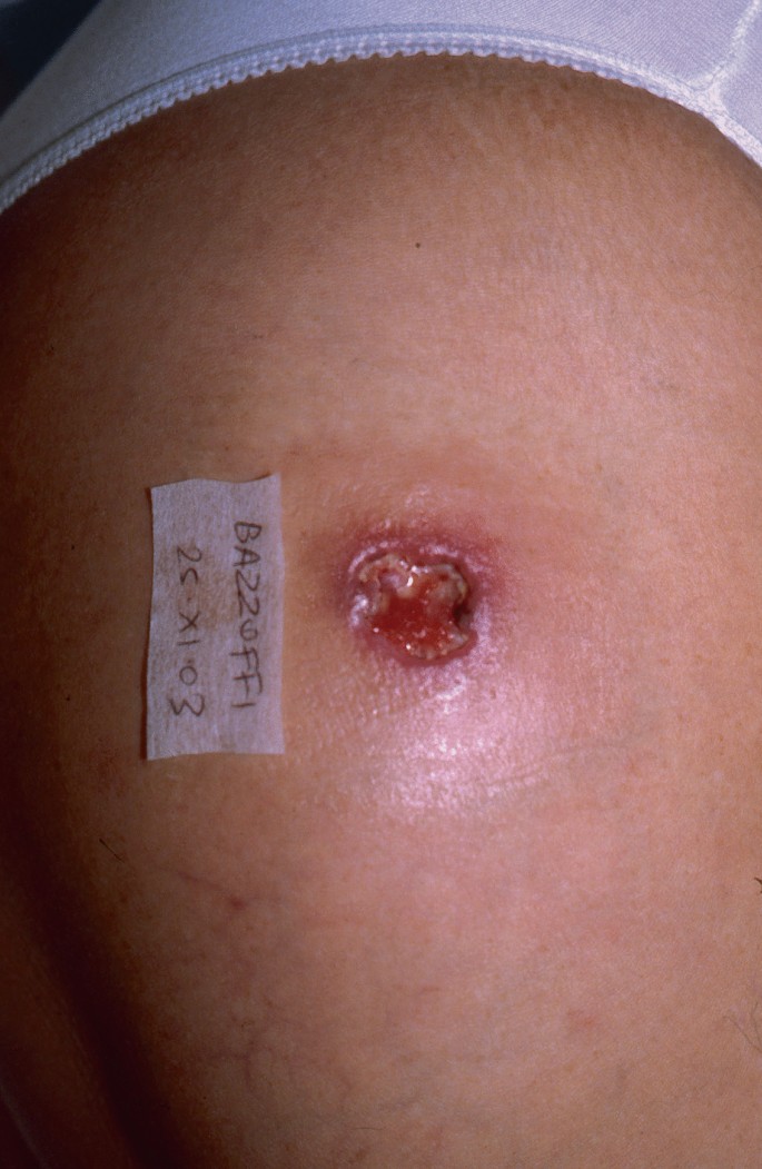 Ulceration of Breast's Skin due to Topical Corticosteroid Abuse - Open  Access Pub