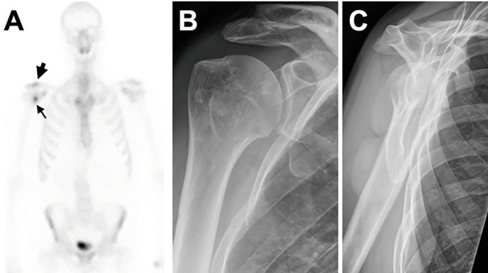 Bone SPECT/CT in Shoulder: Tendinitis Calcarean Subscapularis or ...
