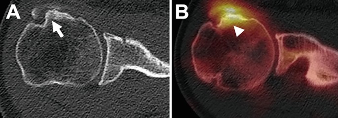 Bone SPECT/CT in Shoulder: Tendinitis Calcarean Subscapularis or ...