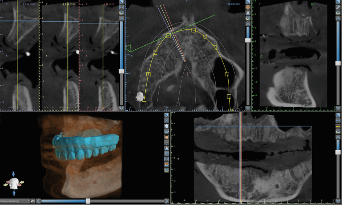 A screengrab of the specific dental implant planning software screen. It contains 4 sets of intra-oral scan images of a patient aligned to C B C T for implant planning. An illustration of the virtual model of the patient’s oral bone with tissue mesh and 3-D structure of the upper jaw and teeth.