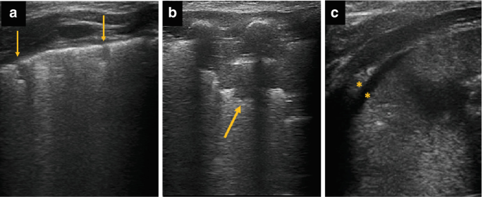 3 ultrasonograms of the lungs of a neonate in different views. a. 2 arrows point to the broken and uneven pleural line. b. An arrow points to the cluster of B lines and non-uniform pleural lines. c. 2 asterisks mark the thick rim of pleural effusion.