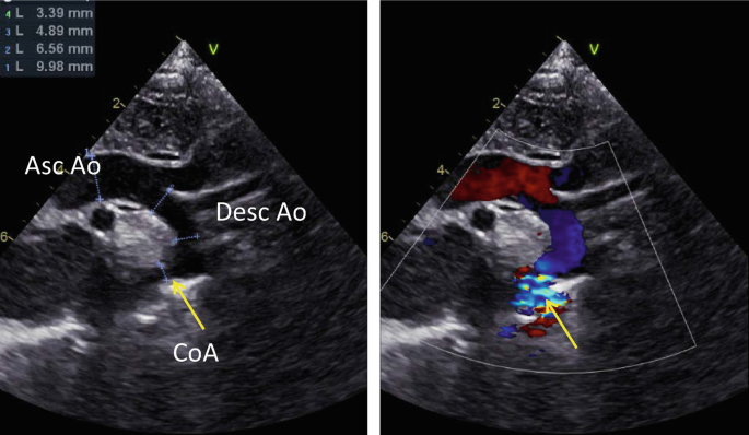 A pair of suprasternal scans of the aorta. The left scan depicts a dark irregular patch on the left, a bright patch in the center, and a tubular mass on the right labeled A s c A o, C o A, and D e s c A o, respectively. An up arrow points to the C o A in the center of the right scan.