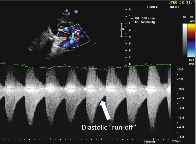 A suprasternal scan of the aorta depicts a continuous wave-like pattern in regular intervals labeled diastolic run-off. An inlet scan of the aorta on the top left highlights it's right part.