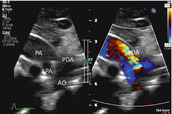 A pair of scans for P S A X depicts irregular dark patches labeled L P A and A o in the center, P A on the left, and P D A on the right. The right scan is overlayed with a heatmap on P D A.