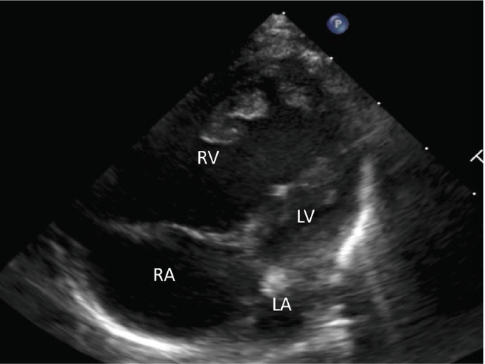 An echocardiography scan depicts a dark patch on the bottom left labeled R A, on the left labeled R V, a tubular dark structure in the center labeled L V, and a shadowy round spot on the bottom labeled L A.