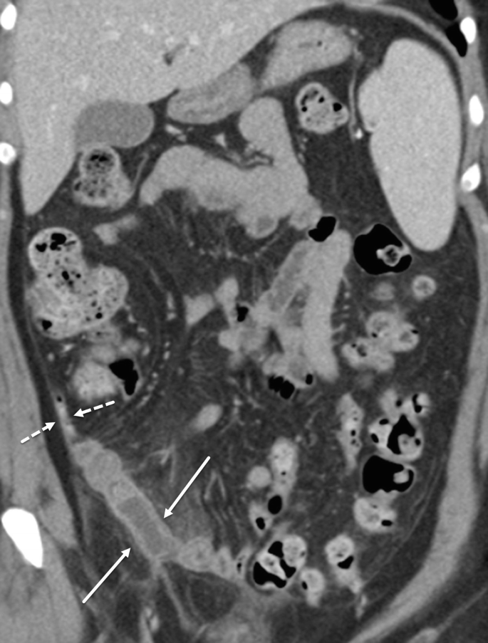 C T image of Meckel diverticulitis. The dotted arrow and solid arrow represent the normal appendix and blind-ending structure. The lightly shaded portion are in different shapes and structure indicating the organs present in the Meckel diverticulitis