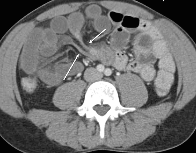 C T image of a small bowel obstruction. The inlet and outlet obstructions are indicated by an arrow. A light-shaded portion is present in the middle of the obstruction.