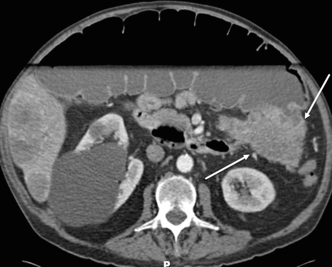 C T image of a large bowel obstruction. The splenic flexure is indicated by an arrow. A light-shaded portion is present in the middle of the obstruction.