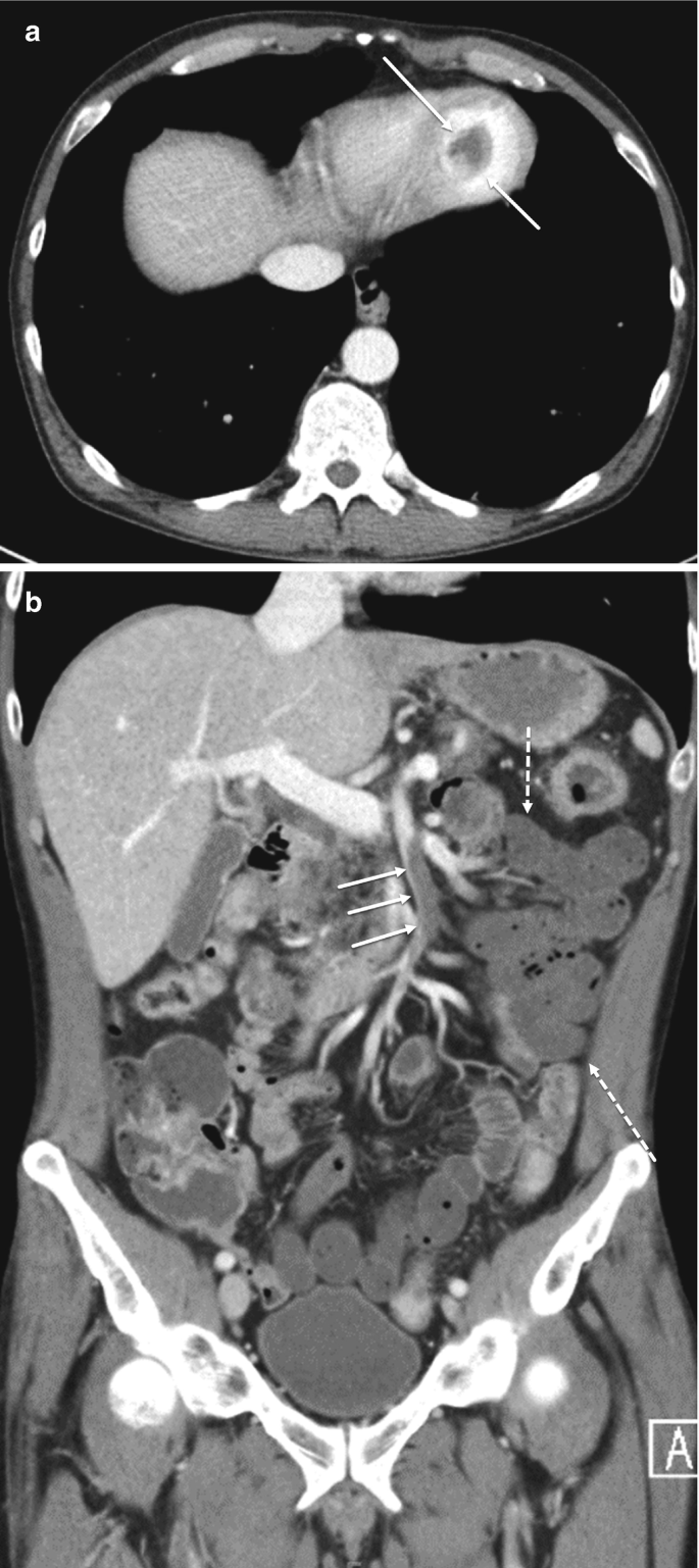 2 C T images of embolic small bowel ischemia. a. An oval-shaped discontinuity is present at the boundary, a lightly shaded portion is indicated by an arrow called a defect in the left ventricle. b. A V-shaped bone structure is present at the bottom, three arrows indicate the region of the superior mesenteric artery.