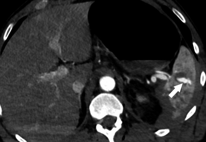 C T scan image of splenic injury. The circular structure on the outer side with oval-shaped dots has some gaps in it. Some portions are lightly shaded in the middle, the arrow indicates the blush of contrast media.