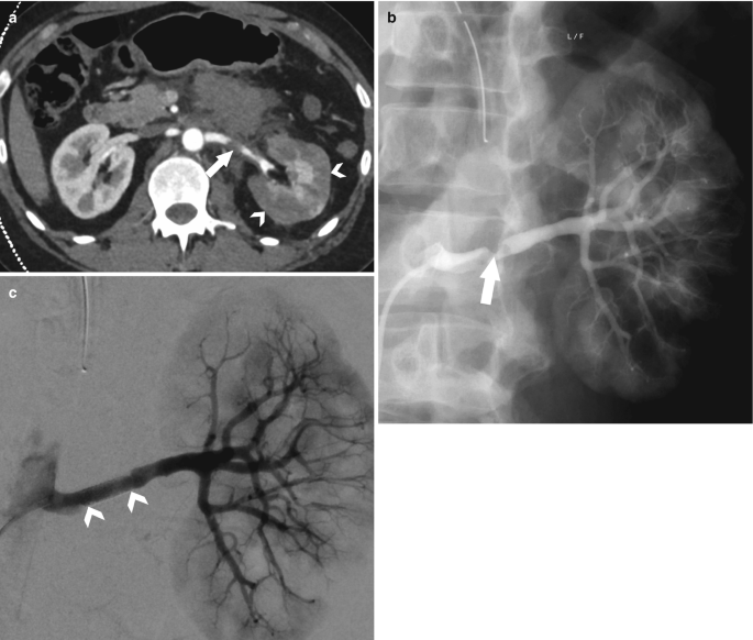 A set of 3 C T scan images of a left renal artery injury. a. the circular structure at the outer side with oval-shaped dots is placed with some gaps in it. Some portions are lightly shaded in the middle, the arrow indicates hypoperfusion of the renal cortex. b. lightly shaded root-like structure. c. darkly shaded root structure after the stunt placement.