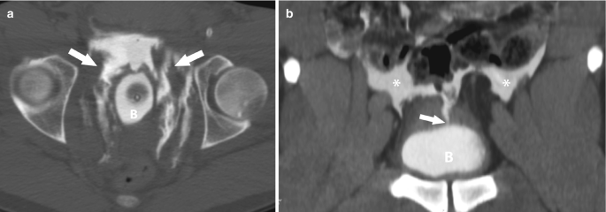 A set of 2 C T images of extraperitoneal and intraperitoneal bladder rupture. a. Two arrows point towards the center of the circle, The dark-shaded circle is on either side of the light-shaded one. b. The light-shaded dome bladder spreading into the top portion is indicated by an asterisk.