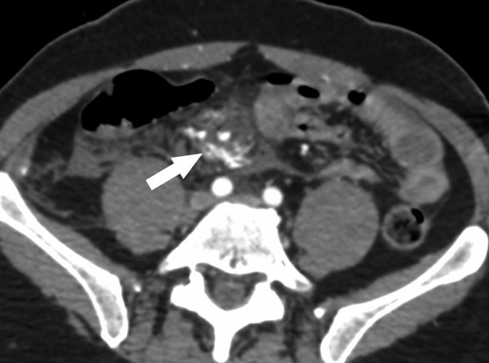 C T image of hematoma in the mesenteric root. The two rod-shaped, light-shaded portions at the two ends, two small circles, and the arrow indicate an actively bleeding mesenteric artery.