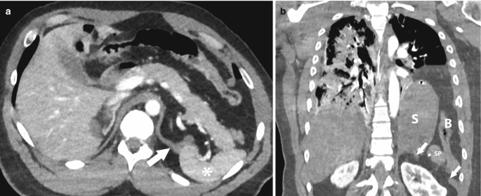 A set of 2 C T images of left hemidiaphragm rupture with organ herniation. a. discontinuity of an oval-shaped structure at the outer boundary, the arrow and star represent the thickening portion and posterior displacement of the spleen. b. A chest portion with the bone, trachea, and diaphragm is bounded by the oval-shaped discontinuity layer.