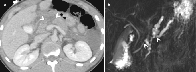 A set of 2 C T images of pancreatic injury. a, three dark-shaded circles with the pancreatic neck are indicated. b. The arrow and the star indicate the portion of the pancreatic duct and pancreatic juice.
